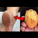 1 картоф = бебешки меки петички. Проста домашна процедура - помага дори при нацепена кожа: