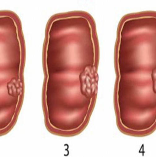 6 тихи симптоми на рак на дебелото черво, които не бива да пренебрегвате!