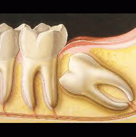 Какво наистина представляват зъбите мъдреци