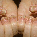 Псориазис и гъбички по ноктите: симптоми, профилактика и 4 начина за премахването му!