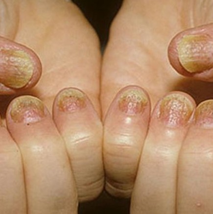 Псориазис и гъбички по ноктите: симптоми, профилактика и 4 начина за премахването му!