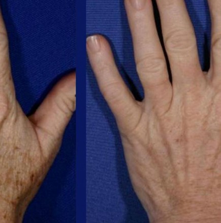 Подмладяване на ръцете: 5 домашни рецепти за премахване на бръчки
