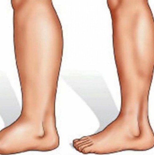 Подути и болезнени крака: 9 причини и 5 ефикасни рецепти
