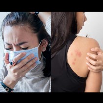5 неприятни кожни симптома, които говорят, че сме пипнали COVID-19 (Снимки):