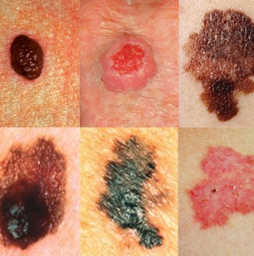 Симптоми на рак на кожата: 5 РАННИ признака на фатално заболяване: