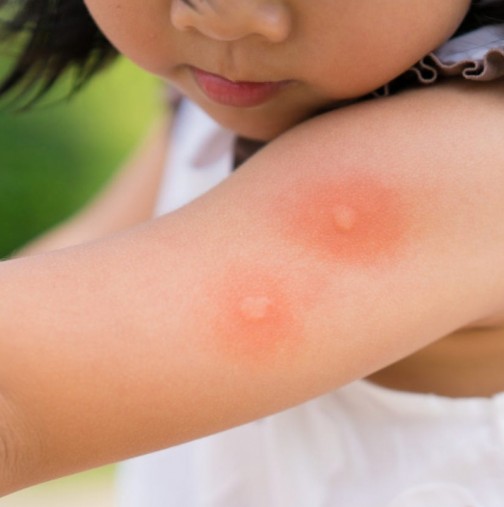 Как се намалява сърбеж след ухапване от комар 