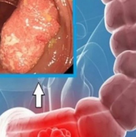 Рак на дебелото черво: 2 признака, които алармират за  незабавно посещение при лекар