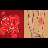 6 симптома, предвестник на опасна ТРОМБОЗА или кръвен съсирек в тялото: