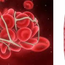 Тези 9 симптома за образуване на опасен кръвен съсирек са полезни за всички!