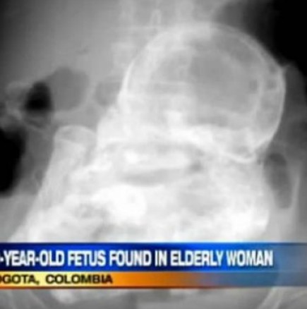84-годишна жена носила 44 години втвърдено бебе в корема си