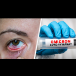 "Розово око" - новият симптом на Омикрон + още 8 нетипични знака, че сте го пипнали:
