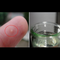 Прост трик за премахване на трънче от пръста - без пинцети и болка!