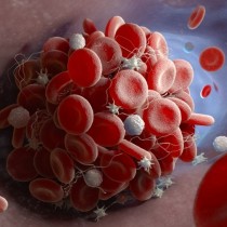 Ако сте от тази кръвна група сте застрашени от тромбоза: