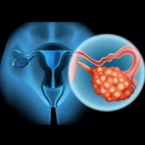 Ракът на яйчниците убива безшумно! Това са 4 ранни симптома, които всяка жена трябва да знае! (+ РЕЦЕПТА)