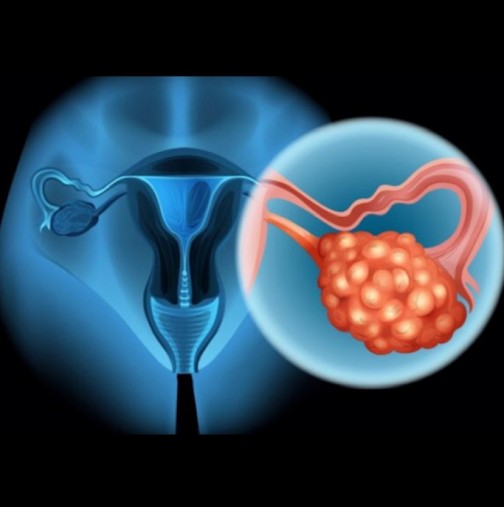 Ракът на яйчниците убива безшумно! Това са 4 ранни симптома, които всяка жена трябва да знае! (+ РЕЦЕПТА)