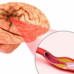 Как се разпознава кръвен съсирек в мозъка, преди да е станала белята