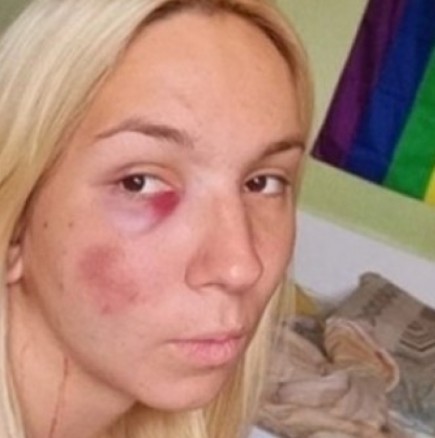 Емили Тротинетката се показа с пораженията след инцидента и проговори за случая