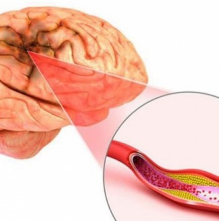 Как се разпознава кръвен съсирек в мозъка, преди да е станала белята