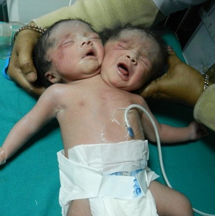 ВИДЕО: Индийка роди бебе с две глави