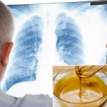 Най-доброто естествено лекарство при бронхопневмония според читателките на "ЗаЖената": кашлицата изчезва за 7 дни!