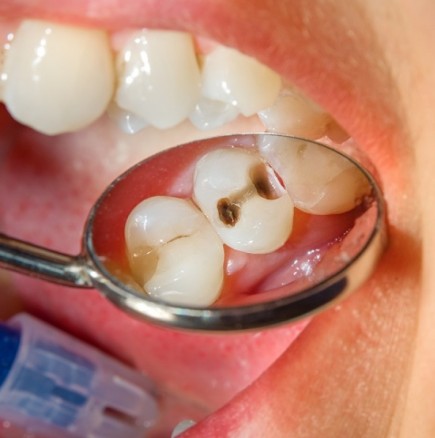 97% от пациентите с рак са имали тази стоматологична процедура преди да се разболеят