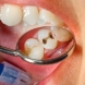 97% от пациентите с рак са имали тази стоматологична процедура преди да се разболеят