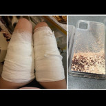 Калъф на телефон причини изгаряния първа степен на жена от Пловдив (СНИМКИ):