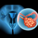 Ракът на яйчниците не мълчи, но е много тих: 4 ранни симптома, които всяка жена трябва да знае! (+Рецепта за природен лек)