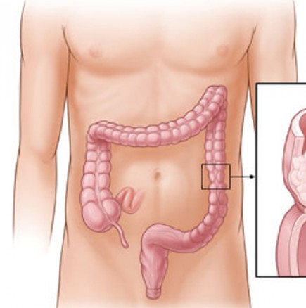 Ракът на дебелото черво е наследствен - Превантивни мерки