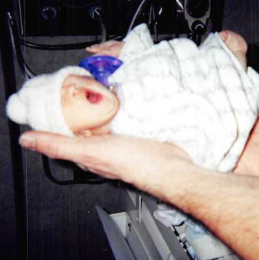 Ето как изглежда 20 години по-късно бебето, което се роди едва 900 грама-Снимки и видео