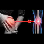 Пукащи и скърцащи колене - първият признак за сериозно състояние на организма