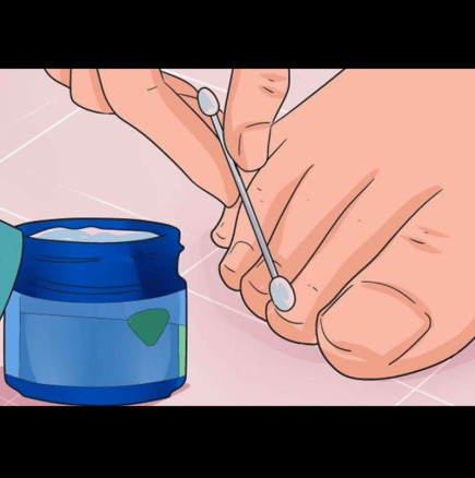 Тези 6 мощни лека ще премахнат и най-пренебрегваните гъбички по ноктите