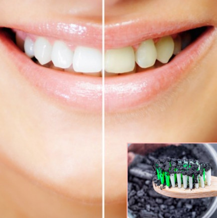 Избелване на зъбите у дома САМО с 1 продукт: красива усмивка за 1 седмица!