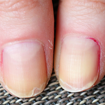 8 витамина срещу чупливи нокти-Липсата на кои витамини води до чупливи нокти, как да предотвратим бедствие