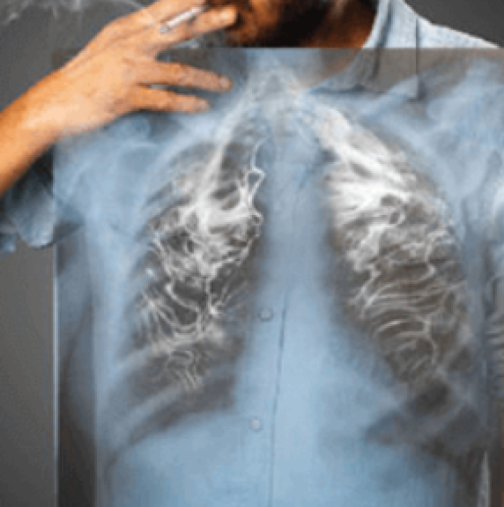 Основно почистване! Чистач за белия дроб се справя с катраните от тютюнопушенето