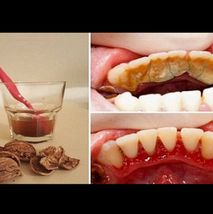 5 работещи метода за почистване на зъбен камък у дома (+ БОНУС-съвет!)