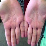 Първите симптоми на раково заболяване се разпознават по дланите