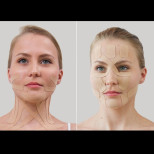 Естетично тейпиране на лице: пълно ръководство за това как да се отървете от бръчките и отоците