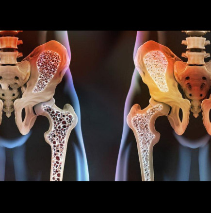 Остеопороза: „Калциевата лъжа“, за която всяка жена трябва да знае