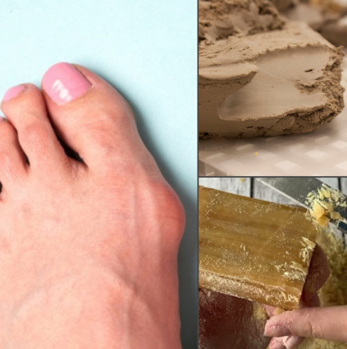 Глина + сапун = Лек №1 при деформирано кокалче на крака (РЕЦЕПТА)