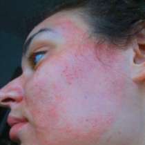 Изгориха лицето на жена с козметична процедура
