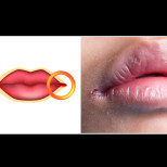 Напукани ъгълчета на устата - съвсем не са безобидни! Ето защо се появяват и как да ги излекуваме?