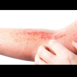 Признаци на рак на кожата могат да се развият само след 15 минути на слънце, ето как да ги разпознаете