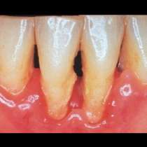 Има ли начини да се избавим от пародонтозата и какви рискове крие за здравето на зъбите ни