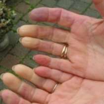 Синдром на Рейно - студени пръсти на ръцете