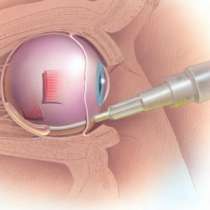 Инжекция в окото предпазва от слепота