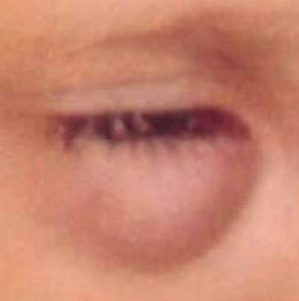 5-годишно дете било ухапано от комар и под окото му се развил червей!(Смущаваща снимка)