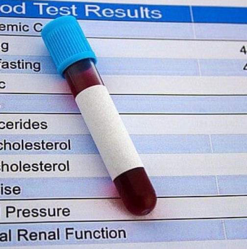 Кардиолог разкри: Оптимални стойности на HDL холестерол, LDL холестерол и триглицериди