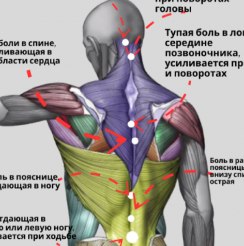 Карта на болките в гърба: Какво ви казва тялото, когато ви боли вратът, долната част на гърба