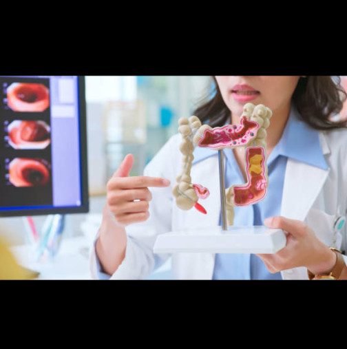 Това са 5 храни, които никой лекар няма да докосне заради риск от рак на дебелото черво